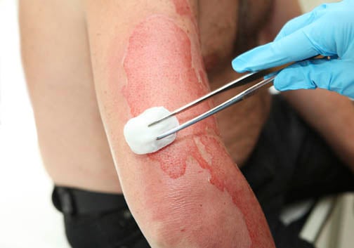 First Aid for Burns – how to reduce pain and scarring - Online First Aid