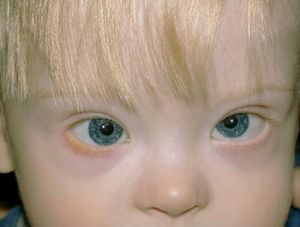 Down syndrome eyes vs regular eyes