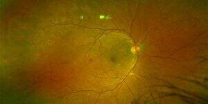 az autoimmun pajzsmirigy-gyulladás hatása a látásra