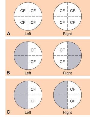 Cf Eye Exam Diagrams