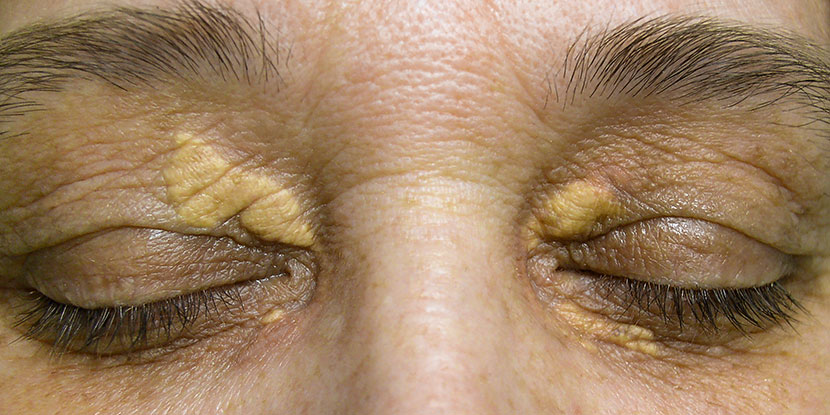What is xanthelasma? - American Academy of Ophthalmology