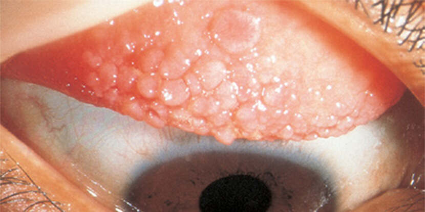giant papillary conjunctivitis human papillomavirus infection in pregnancy