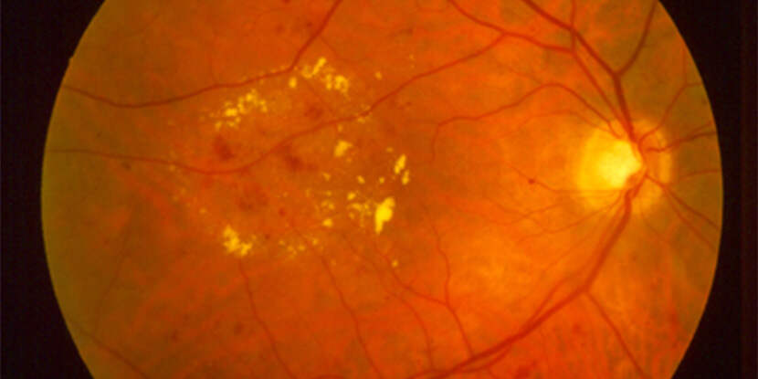 diabetic retinopathy)