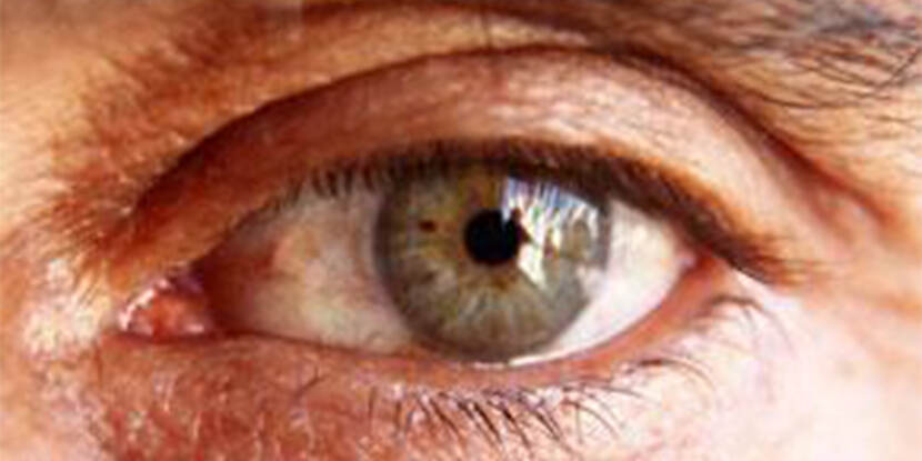 oedema around eye)