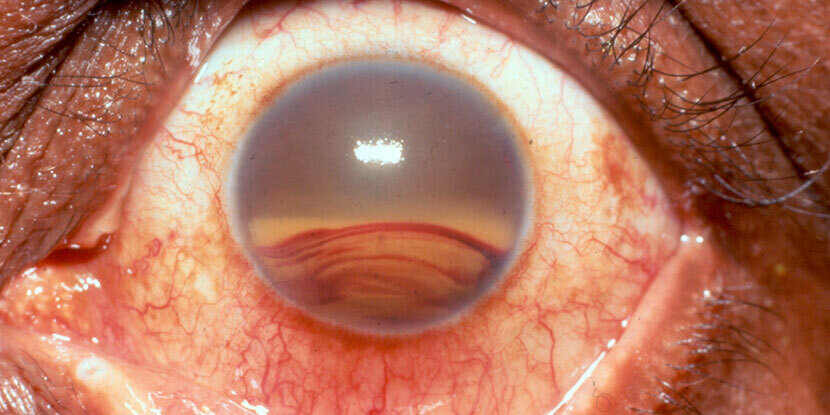 Can you wear contacts with broken blood vessel in eye What Is Hyphema American Academy Of Ophthalmology
