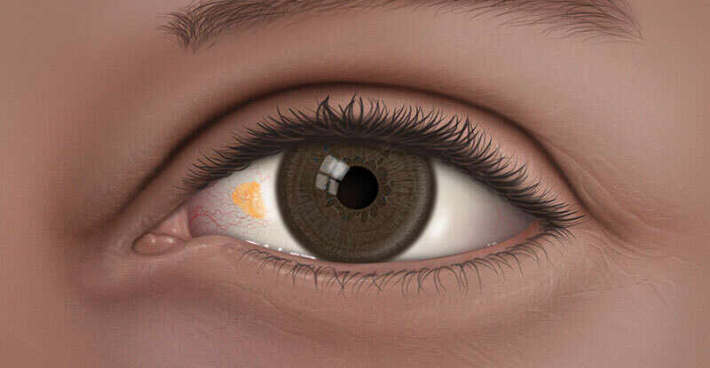 Literele de pe testul ocular se numesc - Testul ZEISS online de verificare a vederii