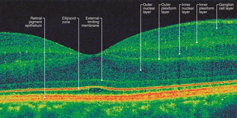 What Is Optical Coherence Tomography? - American Academy of Ophthalmology