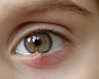 Human papilloma virus ocular. Consecințe ale nu tratării viermilor