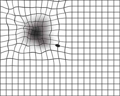 Amsler grid showing distortion of lines on grid that one might see with AMD