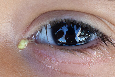 Evite estos cuatro peligros al utilizar los lentes de contacto sin prescripción - American Academy Ophthalmology