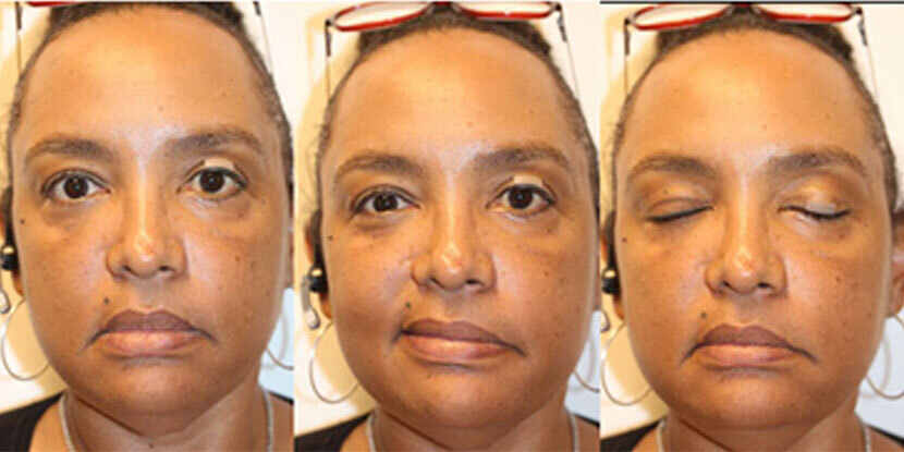 Key Pearls for Managing a Facial Nerve Palsy Patient - American Academy of  Ophthalmology