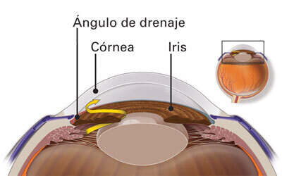 ángulo de drenaje bloqueado - glaucoma