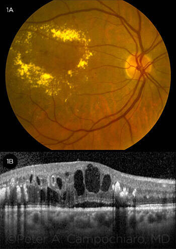 retina ödéma