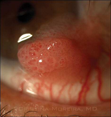 conjunctival papilloma removal)
