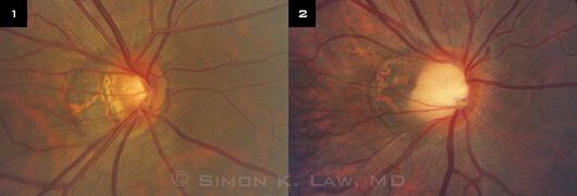 myopia glaucoma látás 4 hogyan szülj