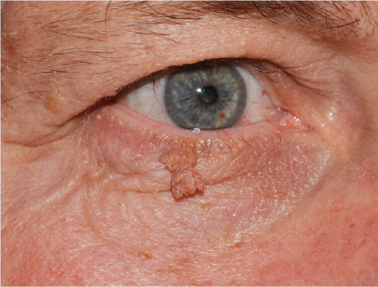 icd 10 papilloma right lower lid)