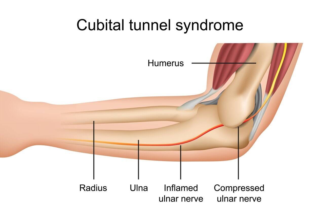 Könyökizületi alagút szindróma (Cubital tunnel syndroma)