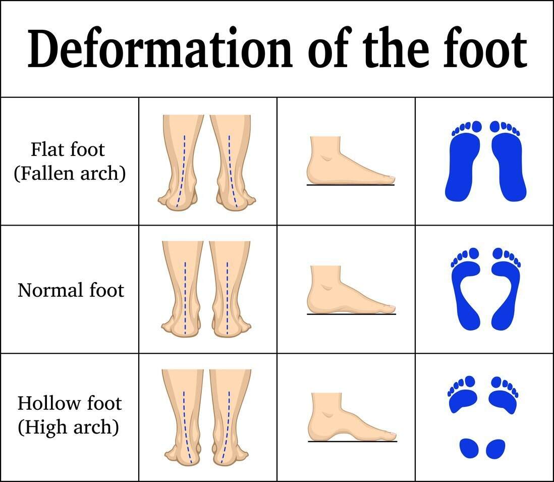 Flexible flatfoot: Foot orthoses and outcomes