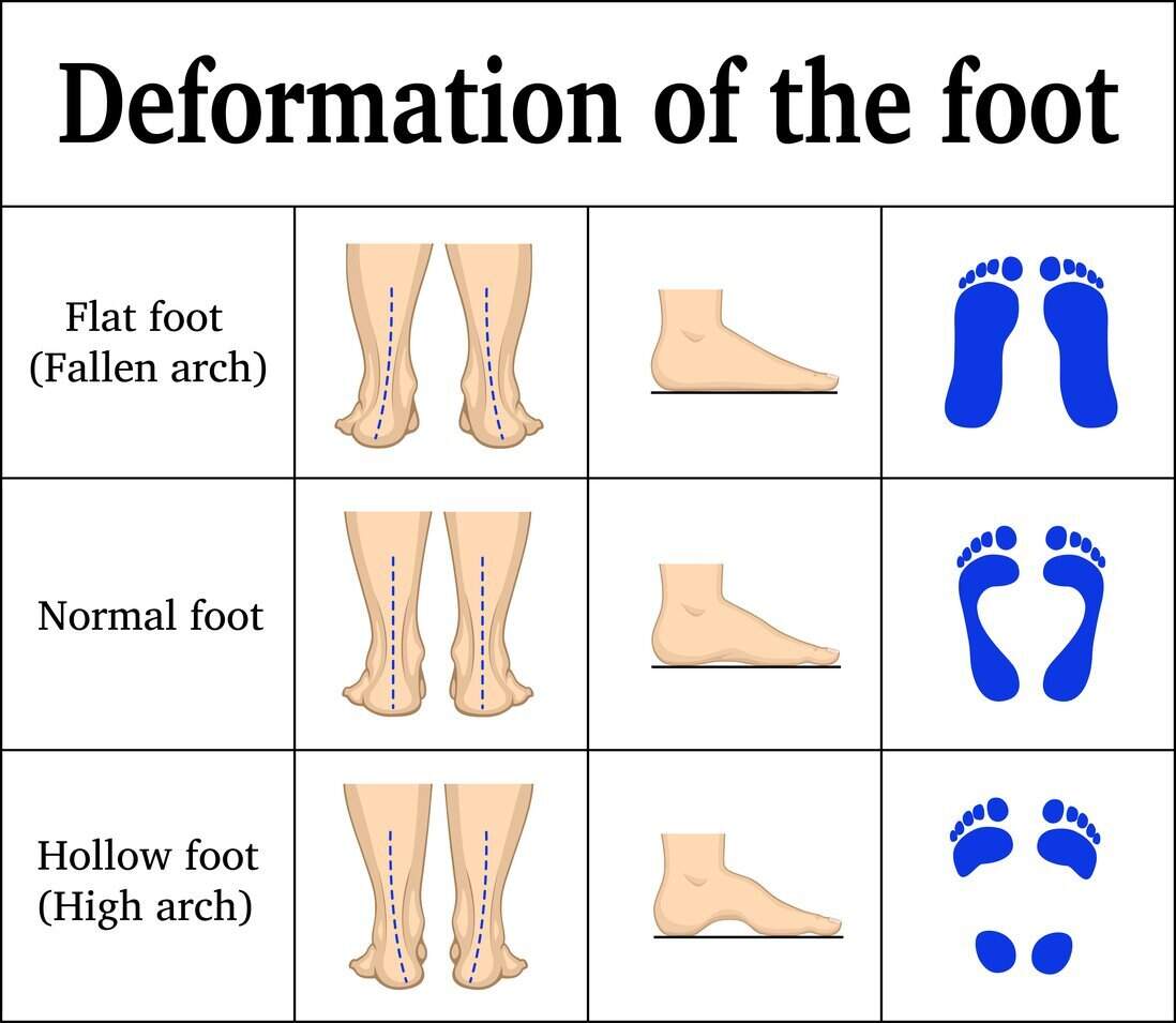 Image of normal arch foot, fallen arch and hollow foot. Orthotics can help with severe flat feet. The flatfoot can cause other issues. image of flatfeet