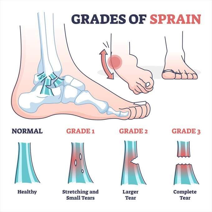 The Lower Ankle Sprain