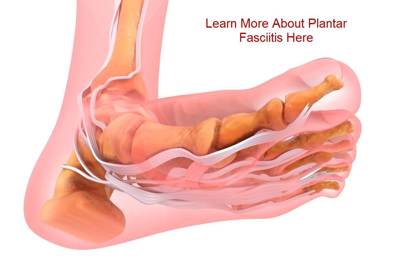 Plantar fascial rupture - Wikipedia