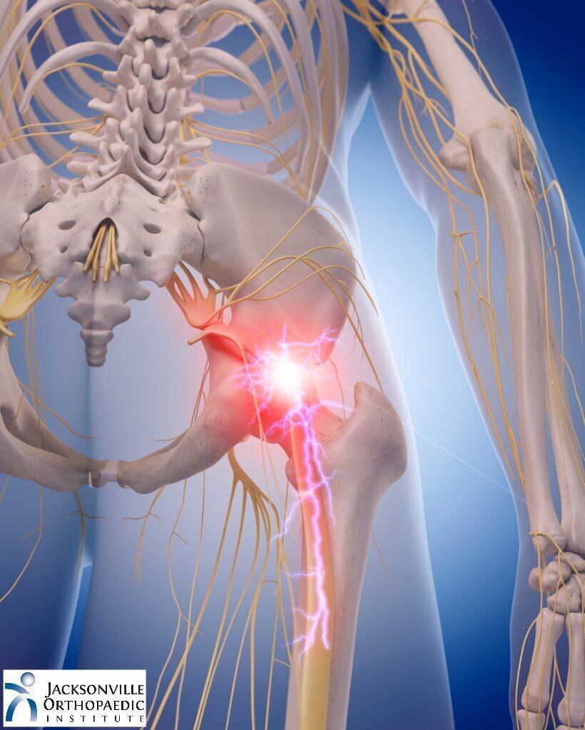 What Causes Sciatica Nerve Pain?   OrthoBethesda