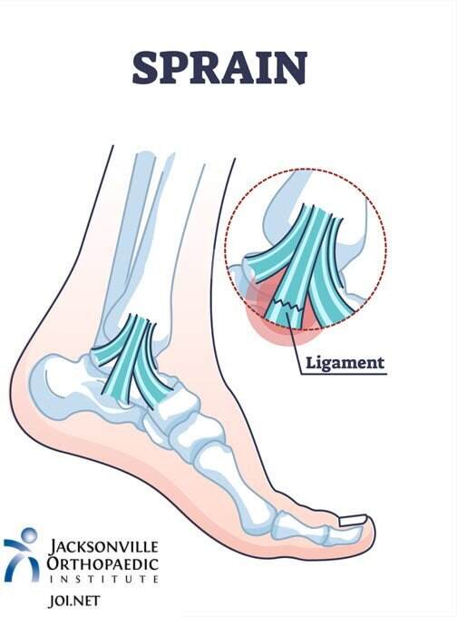 Low Ankle Sprain