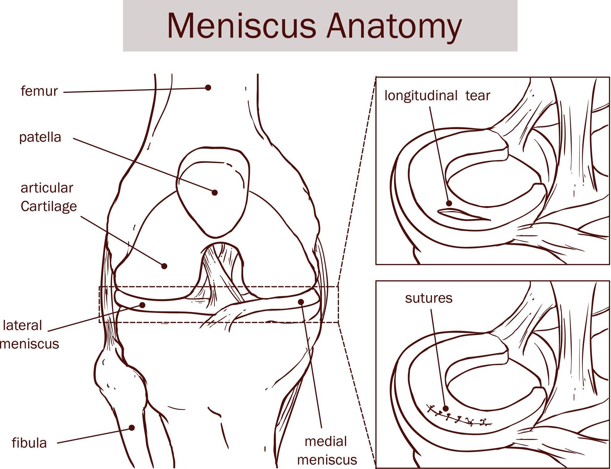 Types Of Meniscus Tears