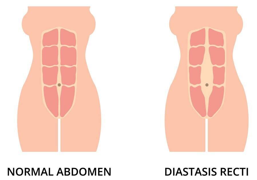 Diastasis Recti (Separated Abdominal Muscles) - Diagnosis, Causes