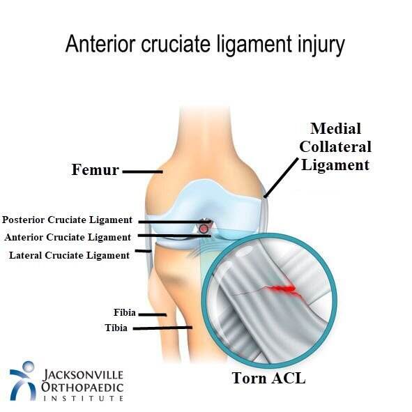 What is an ACL Tear? Part II