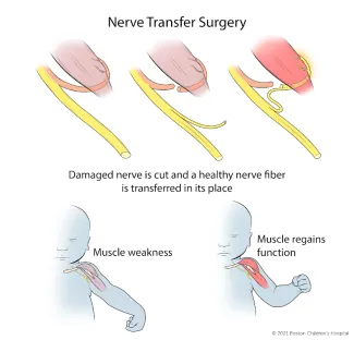 In nerve transfer surgery, the damaged nerve is cut and a healthy nerve fiber is transferred in its place.
