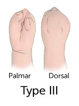 illustration of hands with severe fusing of fingers and joints