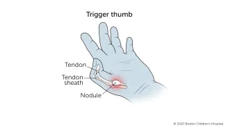 Trigger thumb: A nodule forms in the tendon at the base of the thumb when the tendon becomes too large to move easily inside the sheath that protects it. The thumb becomes stuck in a flexed position.