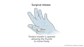 Trigger thumb: During surgery, the sheath around the tendon is opened to allow the thumb to move freely.