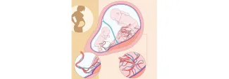 two toned yellow square with a graphic of a pregnant woman outline and of two fetuses in utero with two circles showing a close up of a velamentus umbilical cord insertion and normal umbilical cord insertion 