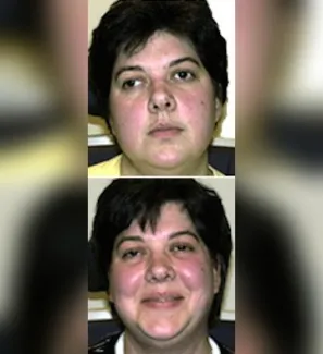 before and after woman with vision therapy