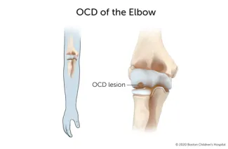 With osteochondritis dissecans of the elbow, a segment of bone in the elbow joint separates from the rest of the bone.