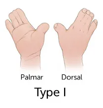 illustration of hands with fingers fused together