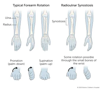 A typical forearm can rotate in both directions: the palm can face all the way down or all the way up. With radioulnar synostosis, the ulna and radius are connected, limiting rotation.
