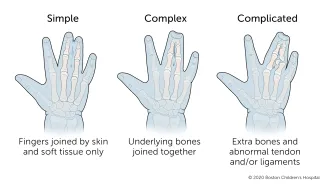 Simple syndactyly means that the fingers are joined by skin and soft tissue only. Complex syndactyly means that underlying bones are also joined together. Complicated syndactyly means that there are extra bones and abnormal tendon and/or ligament development.