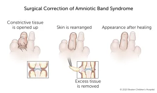 Surgical correction of amniotic band syndrome involves removing constricted tissue and rearranging the skin so that the finger has a more typical appearance.