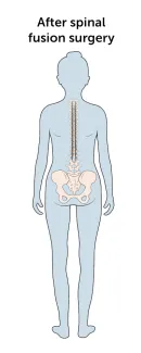 Metal rods, hooks, and screws are attached to the spine in order to stabilize it in an upright position.