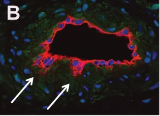 A capillary malformation specimen stained with an endothelial cell marker (red) and a nuclear marker (blue); arrows point to endothelial cells that appear to be sprouting from the vessel, suggesting angiogenic activation. 