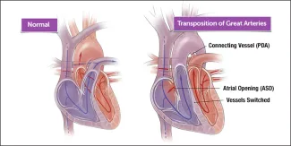 Illustration of a normal heart and a heart with transposition of the great arteries (TGA)