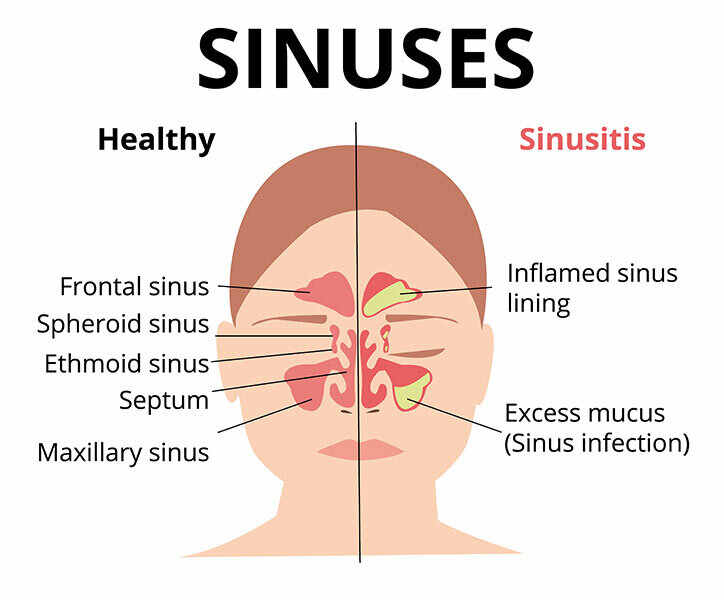 Sinus