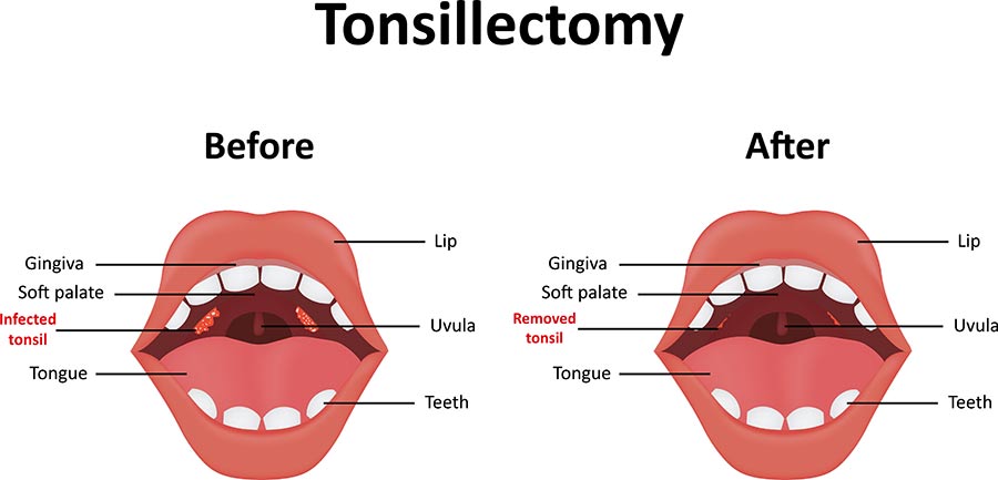 Can You Still Get Strep Without Tonsils And Adenoids Tonsils And Adenoids Tonsillitis