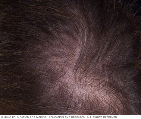 Hair loss | Beacon Health System