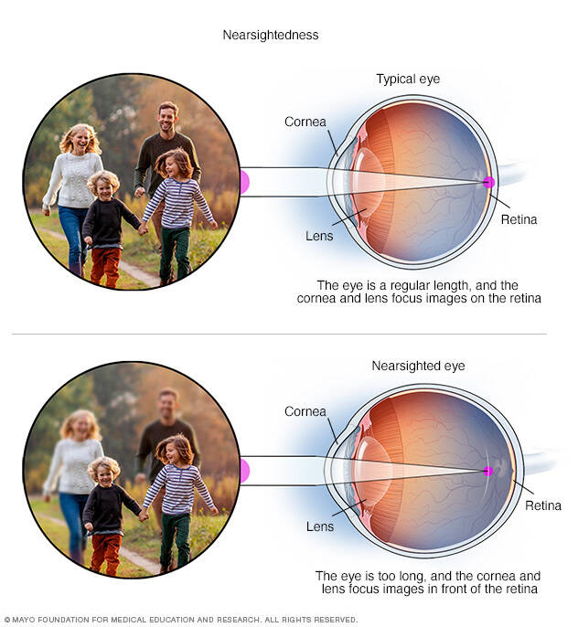 Nearsightedness  Beacon Health System