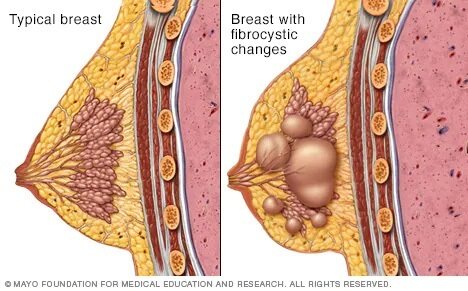 Lump on breast: Types, diagnosis, and other symptoms
