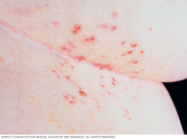 Scabies  Beacon Health System